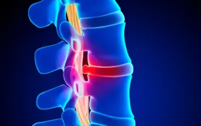 What Is a Herniated Disc? You may have experienced one.