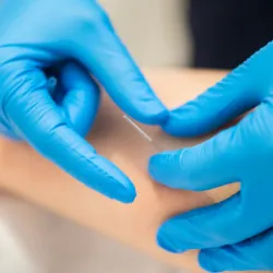 FAQs About Dry Needling